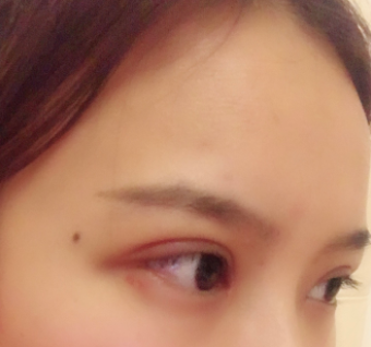 長(zhǎng)春麥西美嘉整形醫(yī)生王圣博做雙眼皮手術(shù)效果怎么樣？附雙眼皮案例