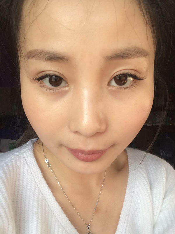 桂林新華醫(yī)療美容醫(yī)生李新華做雙眼皮手術(shù)怎么樣？李新華雙眼皮手術(shù)案例