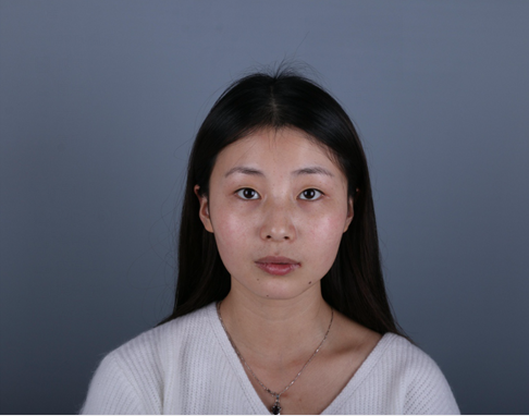 桂林新華醫(yī)療美容醫(yī)生李新華做雙眼皮手術怎么樣？李新華雙眼皮手術案例