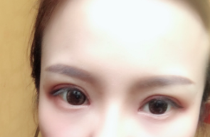 長春麥西美嘉整形醫(yī)生王圣博做雙眼皮手術(shù)效果怎么樣？附雙眼皮案例