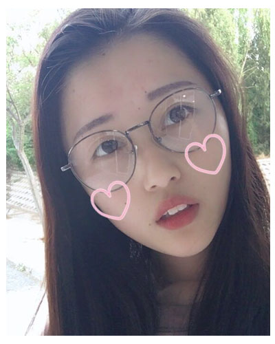 義烏傅氏口腔醫(yī)生朱雨晴做牙齒隱形矯正效果怎么樣？附牙齒隱形矯正案例