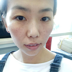 珠海蒂伊醫(yī)療整形醫(yī)生廖俊凱做激光祛斑效果怎么樣？附激光祛斑案例效果圖