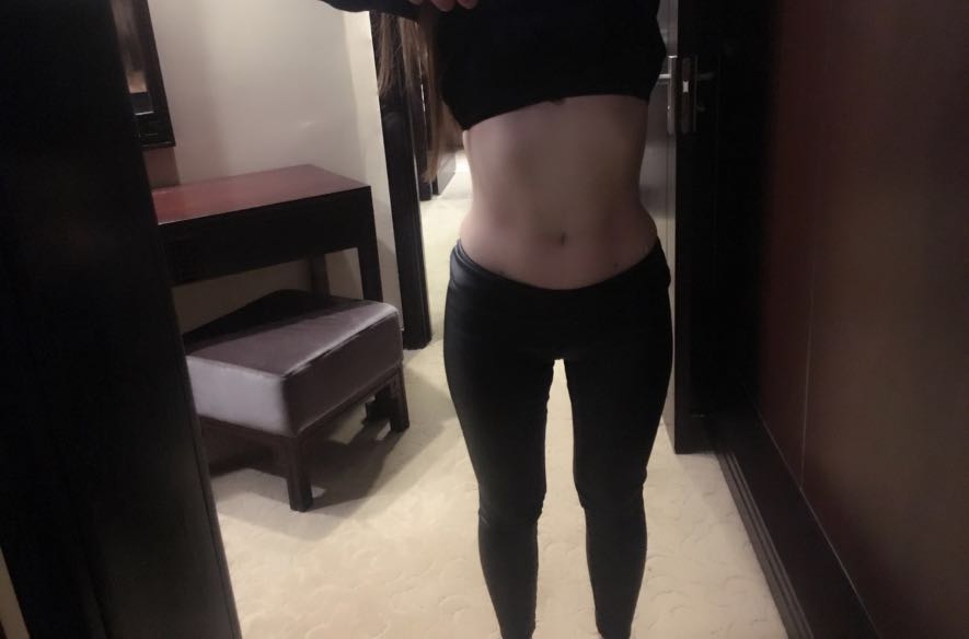 肇慶華美整形醫(yī)院陳巍醫(yī)生做腰腹吸脂效果怎么樣？附腰腹吸脂案例