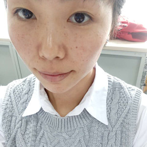 珠海蒂伊醫(yī)療整形醫(yī)生廖俊凱做激光祛斑效果怎么樣？附激光祛斑案例效果圖