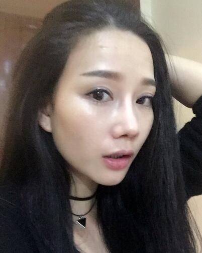 西安陽光整形醫(yī)院邵萍醫(yī)生做鼻綜合整形怎么樣？附鼻綜合整形案例