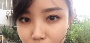 長沙微笑醫(yī)療整形醫(yī)生段雙軍做切開雙眼皮+開內眼角效果怎么樣？附案例