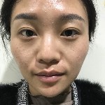 石家莊雅芳亞整形醫(yī)生王文明做雙眼皮+開眼角+鼻綜合整形案例效果對(duì)比圖