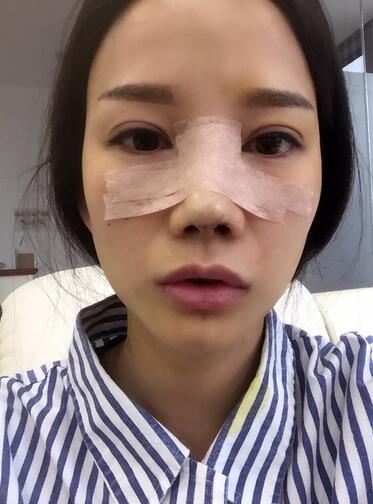 西安陽光整形醫(yī)院邵萍醫(yī)生做鼻綜合整形怎么樣？附鼻綜合整形案例