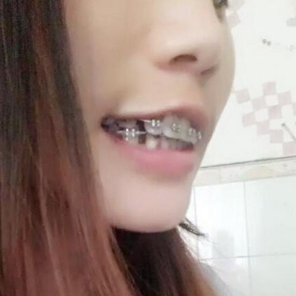 武漢立美整形醫(yī)院張智星醫(yī)生做牙齒矯正效果怎么樣？附牙齒矯正案例