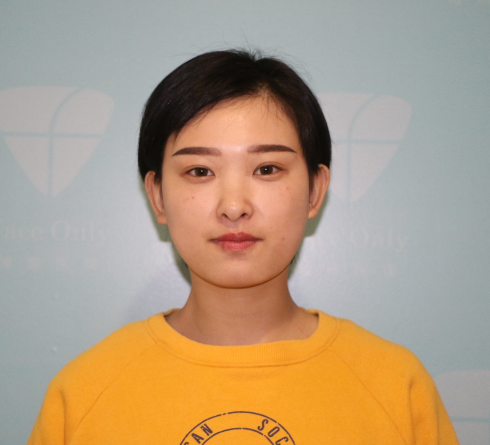 武漢肽慕醫(yī)美整形醫(yī)院楊婉菱醫(yī)生做面部吸脂效果怎么樣？附面部吸脂案例