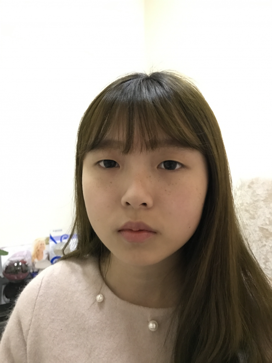 西安米蘭柏羽整形醫(yī)院李旭平做雙眼皮+開眼角技術(shù)怎么樣？附醫(yī)院案例