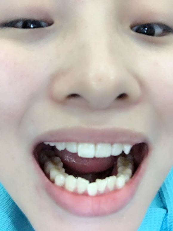 重慶齊美口腔周映丞醫(yī)生做牙齒隱形矯正怎么樣？附牙齒隱形矯正案例