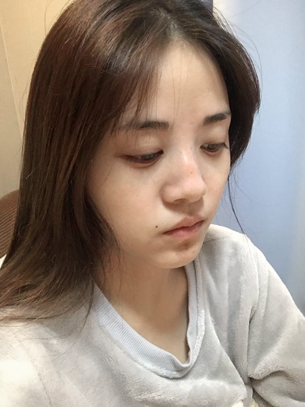 駐馬店締萊美醫(yī)療整形醫(yī)生李冰做鼻綜合整形怎么樣？附鼻綜合整形案例效果對比圖