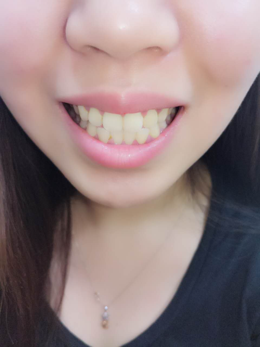杭州國雅口腔醫(yī)院張虹醫(yī)生做冷光美白效果怎么樣？附冷光美白案例效果對比圖