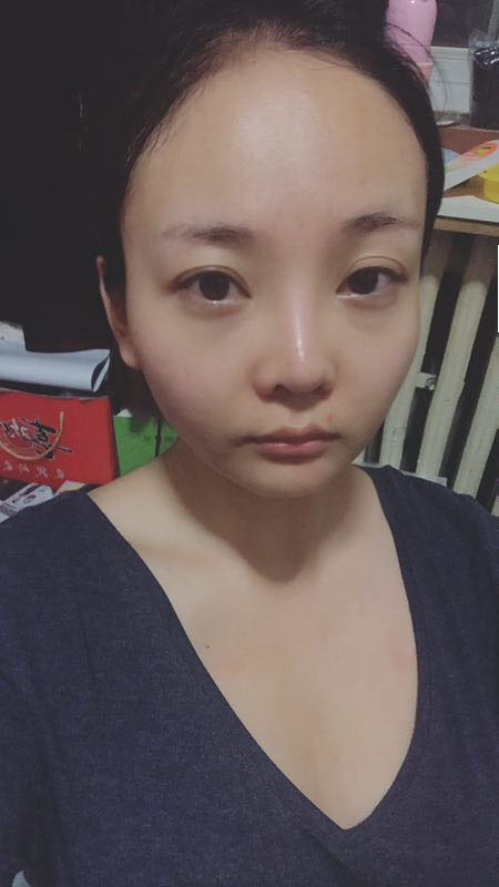 北京可思美醫(yī)療整形醫(yī)生蘇靜做臉部自體脂肪填充效果怎么樣？
