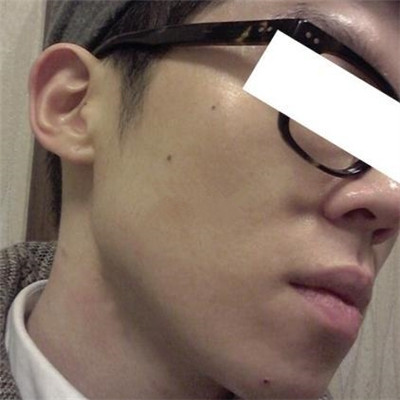 浙江綠城醫(yī)院整形美容中心丁路醫(yī)生做激光祛痘效果怎么樣，附案例對比圖