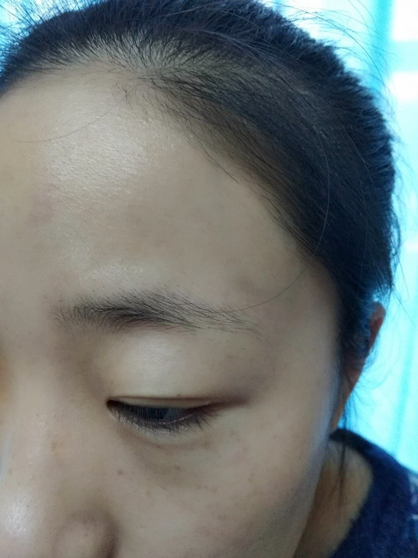長沙愛思特醫(yī)療美容醫(yī)院做半永久紋眉怎么樣？附彭子娟醫(yī)生案例效果圖