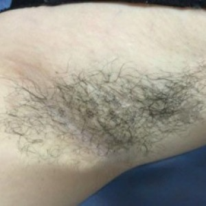 廈門張銘整醫(yī)療整形醫(yī)生張小玲做激光脫腋毛怎么樣？附激光脫腋毛效果對比圖