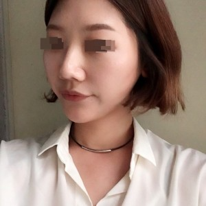 太原麗都整形醫(yī)院劉晉艷醫(yī)生做光纖溶脂瘦臉怎么樣？附案例效果對比圖