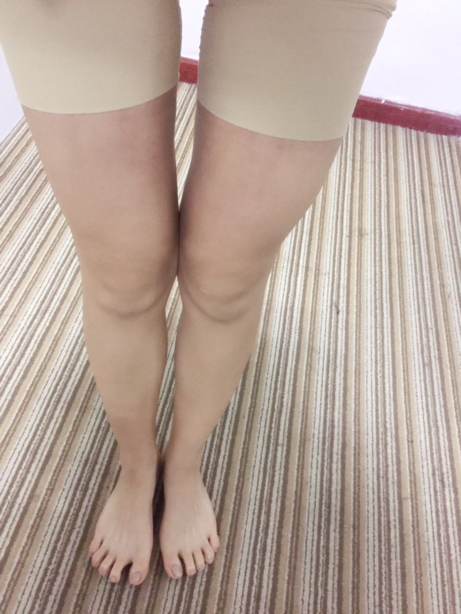 北京蒂凡妮整形靳玉彪醫(yī)生做大腿吸脂怎么樣？附大腿吸脂案例效果對比圖