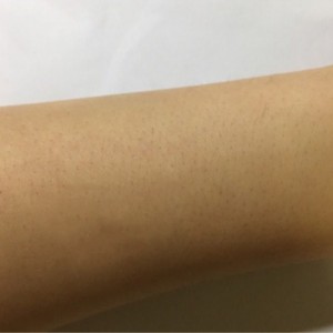 鄭州屈小麗醫(yī)療整形醫(yī)院醫(yī)生劉丹做手臂脫毛怎么樣？附手臂脫毛案例