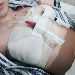 廣州廣大整形美容醫(yī)院醫(yī)生查旭山做假體隆胸怎么樣？附案例