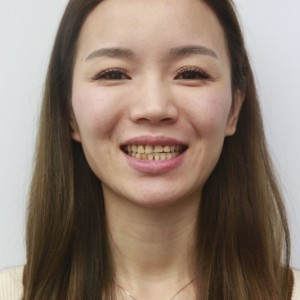 安慶渡江口腔醫(yī)院張良斌醫(yī)生牙齒貼面怎么樣？附牙齒貼面效果圖