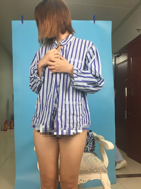 北京蒂凡妮整形靳玉彪醫(yī)生做大腿吸脂怎么樣？附大腿吸脂案例效果對比圖