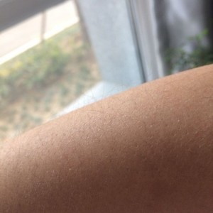 鄭州屈小麗醫(yī)療整形醫(yī)院醫(yī)生劉丹做手臂脫毛怎么樣？附手臂脫毛案例