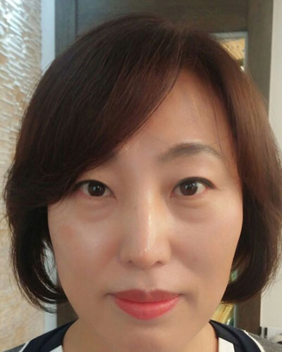 北京四季美學(xué)炫美整形醫(yī)生高玲做埋線祛眼袋怎么樣？附案例效果對比圖