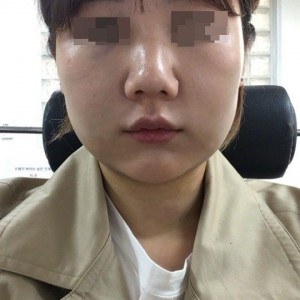 太原麗都整形醫(yī)院劉晉艷醫(yī)生做光纖溶脂瘦臉怎么樣？附案例效果對比圖