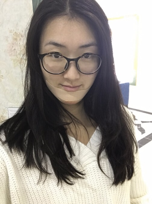 武漢中翰整形外科醫(yī)院做硅膠墊下巴怎么樣？附朱紅霞醫(yī)生案例效果對比圖