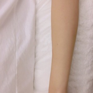 鄭州屈小麗醫(yī)療整形醫(yī)院醫(yī)生劉丹做手臂脫毛怎么樣？附手臂脫毛案例