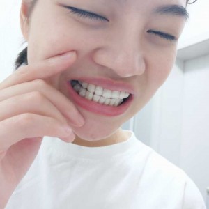 廈門拜博口腔醫(yī)院醫(yī)生張忠做牙齒隱形矯正怎么樣？附案例效果對比圖