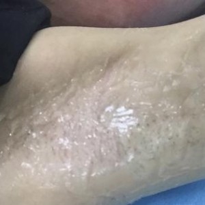 廈門張銘整醫(yī)療整形醫(yī)生張小玲做激光脫腋毛怎么樣？附激光脫腋毛效果對比圖