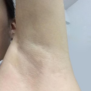 廈門張銘整醫(yī)療整形醫(yī)生張小玲做激光脫腋毛怎么樣？附激光脫腋毛效果對比圖
