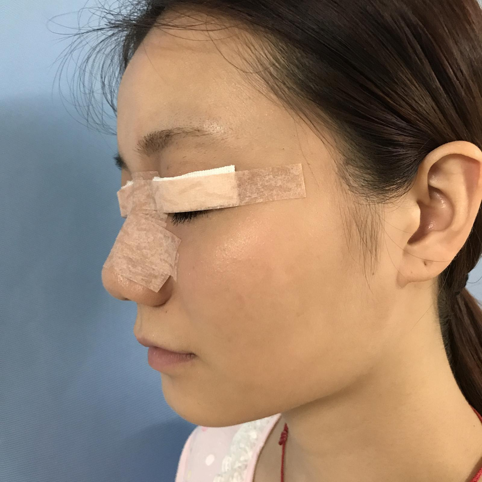武漢華美整形醫(yī)院醫(yī)生王向陽做眼綜合整形怎么樣？附案例效果圖
