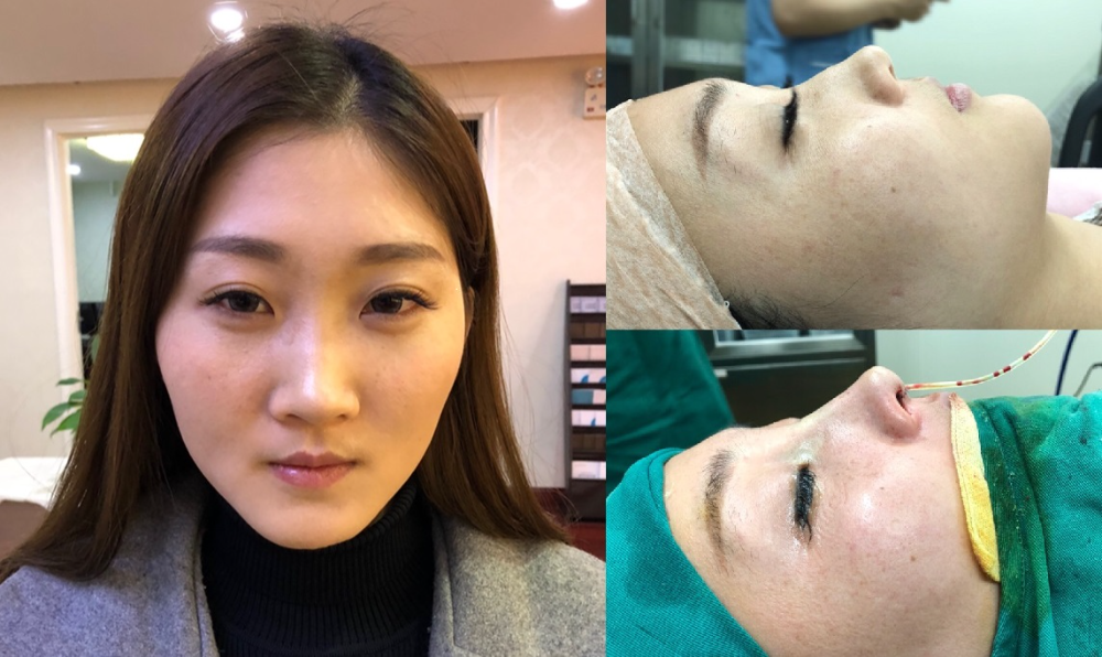 上海首爾麗格醫(yī)療美容醫(yī)院醫(yī)生樸晟秀做膨體隆鼻怎么樣？附案例效果圖
