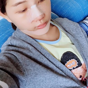 北京京民醫(yī)院整形外科醫(yī)生李鴻儒做硅膠隆鼻怎么樣？附案例效果圖