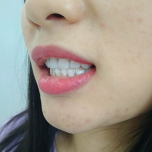洛陽友好口腔醫(yī)院醫(yī)生李新然做牙貼面怎么樣？附案例效果圖