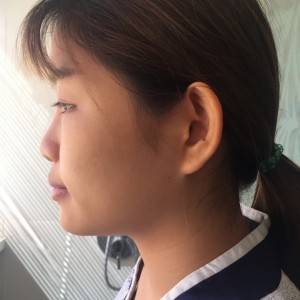 北京京民醫(yī)院整形外科醫(yī)生李鴻儒做硅膠隆鼻怎么樣？附案例效果圖