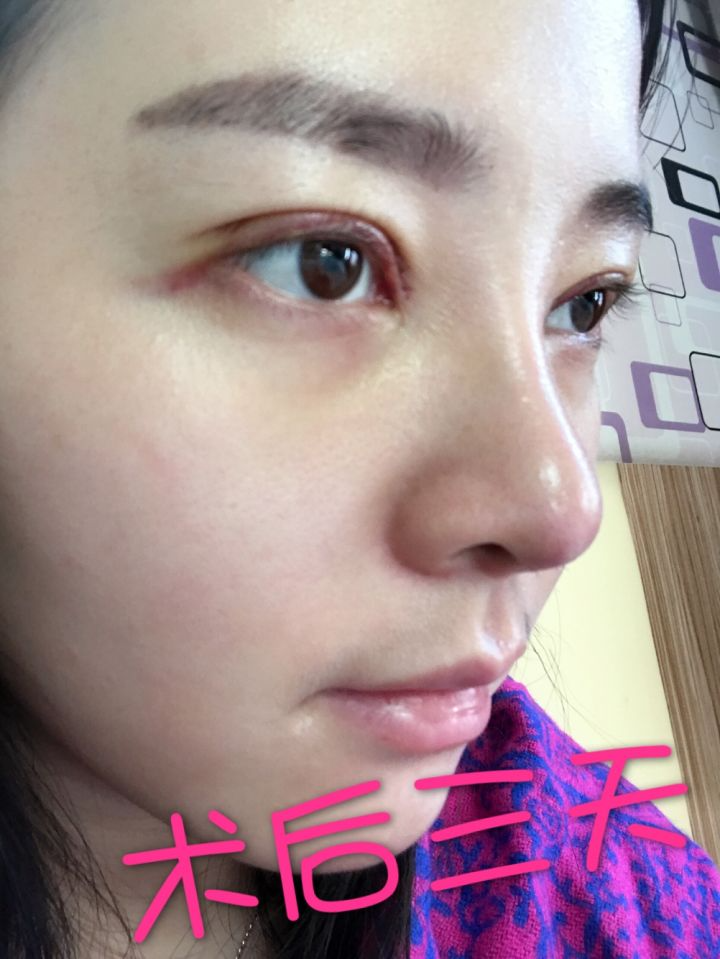 北京京韓整形醫(yī)生王義山做埋線雙眼皮怎么樣？附案例效果對比圖