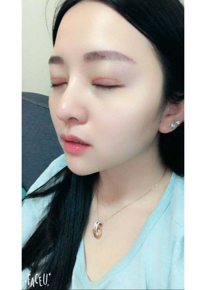 北京京韓整形醫(yī)生王義山做埋線雙眼皮怎么樣？附案例效果對比圖