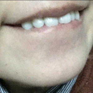 洛陽(yáng)友好口腔醫(yī)院醫(yī)生楊愛芳做牙齒冷光美白怎么樣？附案例效果圖