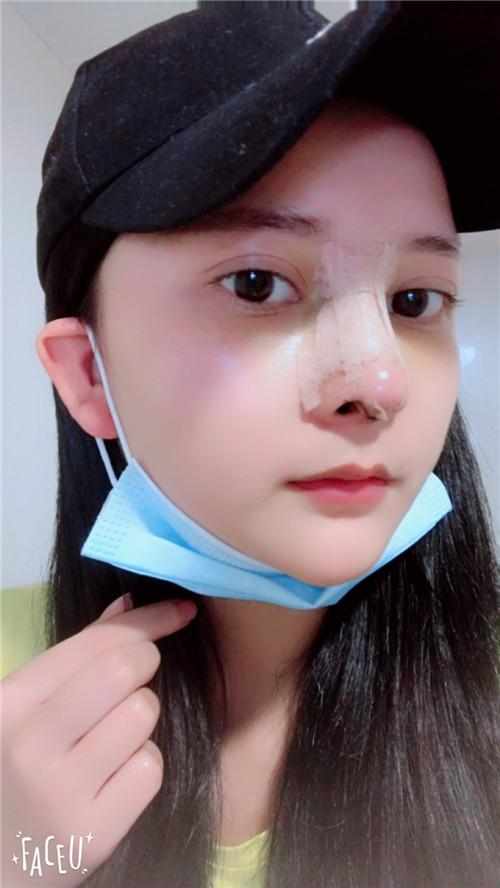 鄭州華領(lǐng)醫(yī)療美容醫(yī)院醫(yī)生張永濤做硅膠假體隆鼻怎么樣？附案例效果對比圖