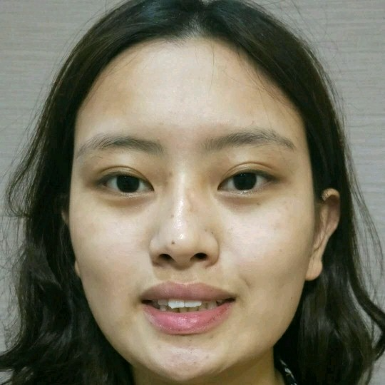 廣州愛來整形醫(yī)院醫(yī)生肖大衛(wèi)做激光點痣怎么樣？附案例效果對比圖