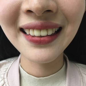 上?？仆呖谇会t(yī)院醫(yī)生鄧建儒做牙齒冷光美白怎么樣？附案例效果對比圖