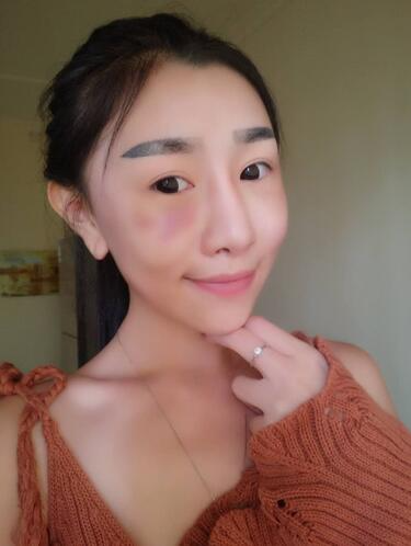 貴陽(yáng)泰康樂(lè)醫(yī)院整形美容科醫(yī)生陳璐做自體脂肪全臉填充效果怎么樣？