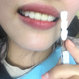 上海科瓦口腔醫(yī)院醫(yī)生鄧建儒做牙齒冷光美白怎么樣？附案例效果對比圖