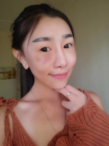 貴陽(yáng)泰康樂醫(yī)院整形美容科醫(yī)生陳璐做自體脂肪全臉填充效果怎么樣？